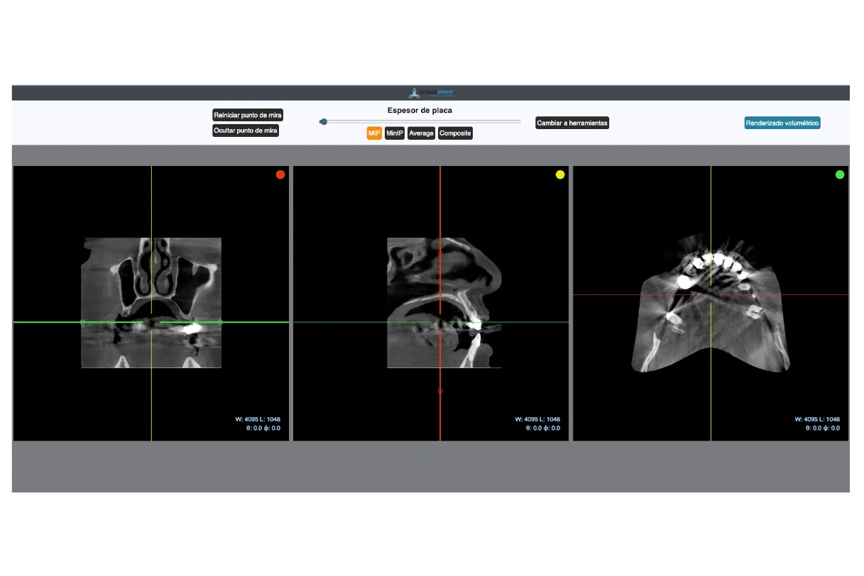 Visor DICOM de imágenes dentales (cortes multiplanares de TAC) en ActualPACS Dental