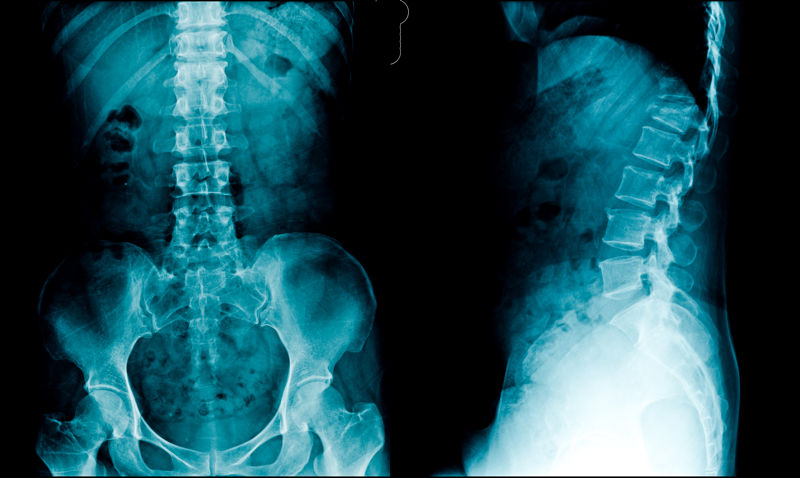 En qué consiste la radiografía de columna lumbosacra?