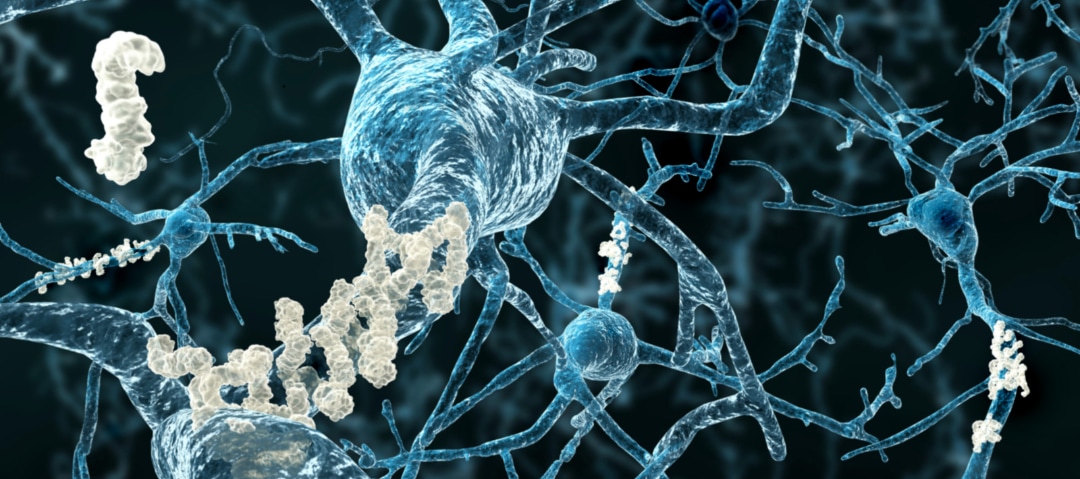 Diferenciar entre deterioro cognitivo progresivo o estable puede cambiar el futuro del Alzheimer