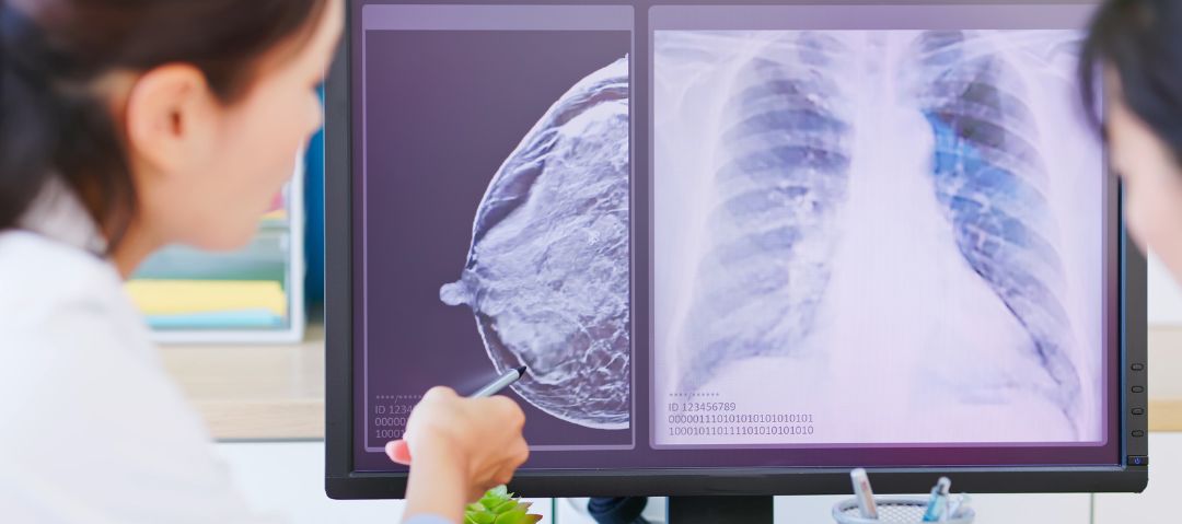 La IA ayuda a radiólogos a detectar con precisión el cáncer de mama en imágenes de ultrasonido